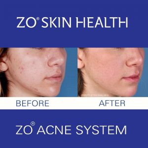 Tratamiento del acné ZO