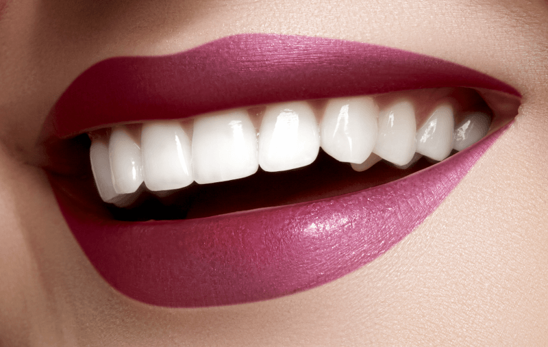 Teeth Whitening in Baker Street