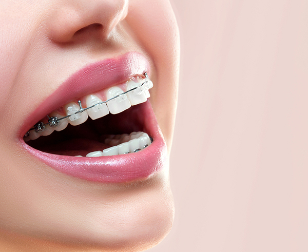 Invisalign avant / après : 3 exemples de traitements avec gouttières