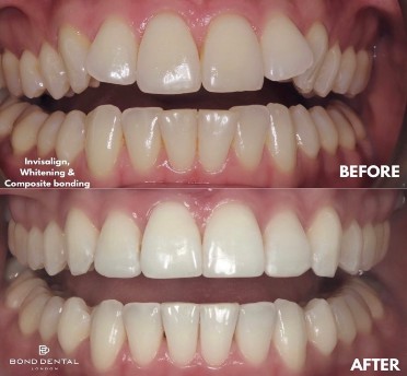 Composite bonding in London Ontario - Sbenati Dentistry