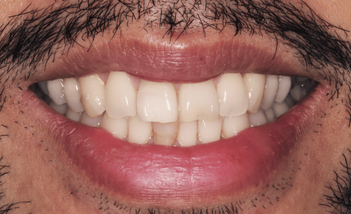 Before - Bond Dental London