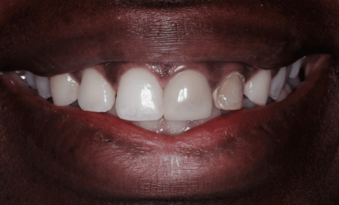 Before - Bond Dental London