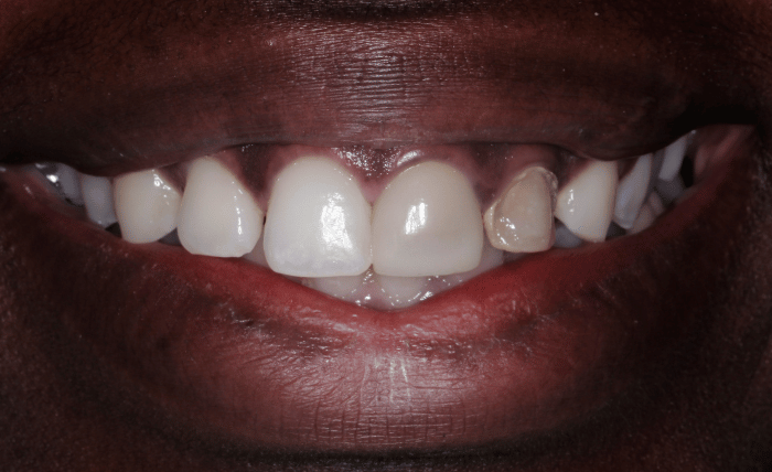 Before - Bond Dental London