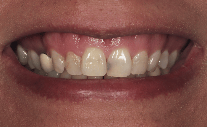 Before - Bond Dental London