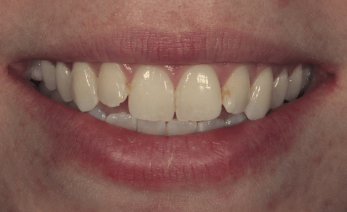Before - Bond Dental London