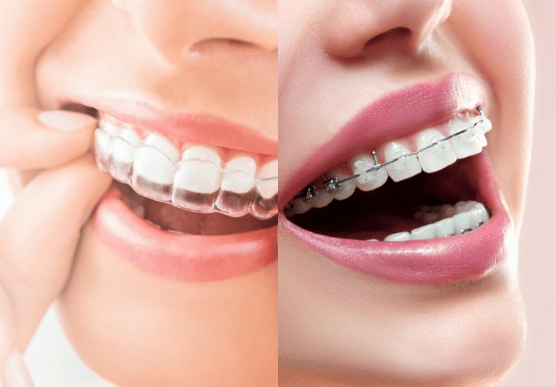 Blog -Bond Dental London