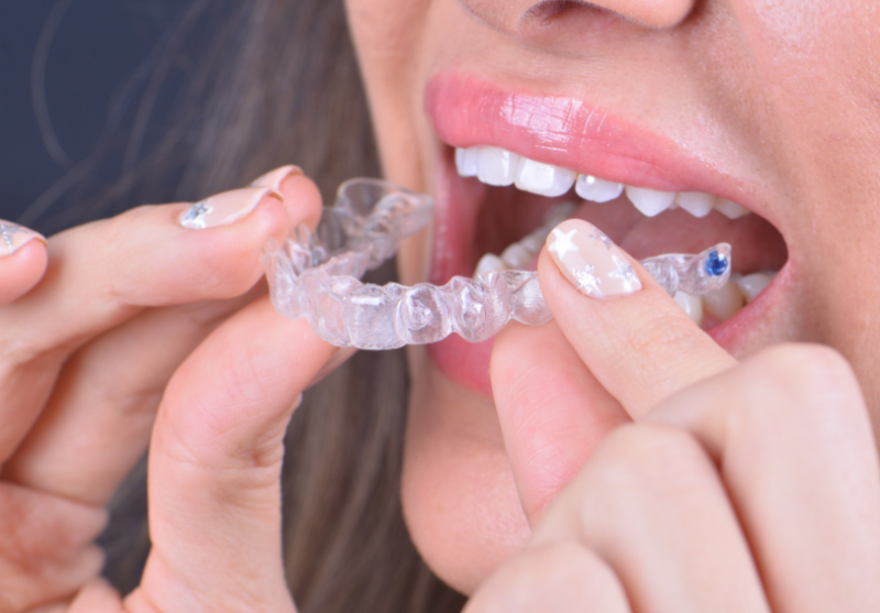 Invisalign Aligners