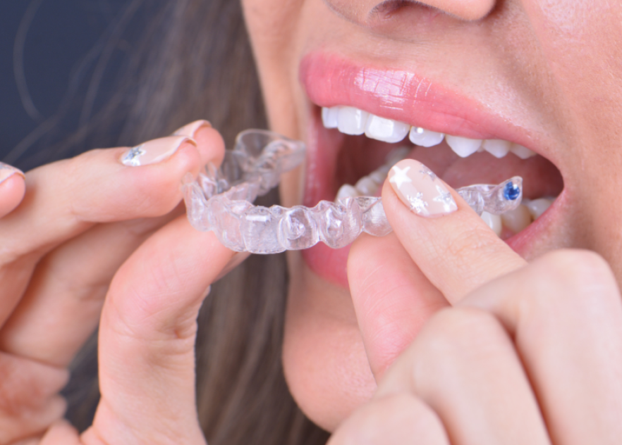 Invisalign Aligners