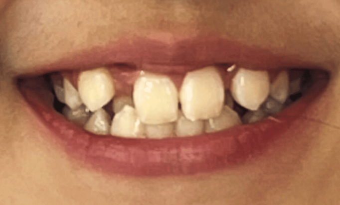Before - Bond Dental London