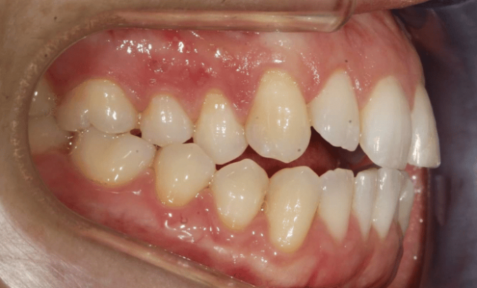 Before - Bond Dental London