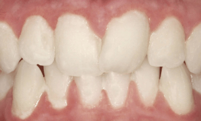Before - Bond Dental London