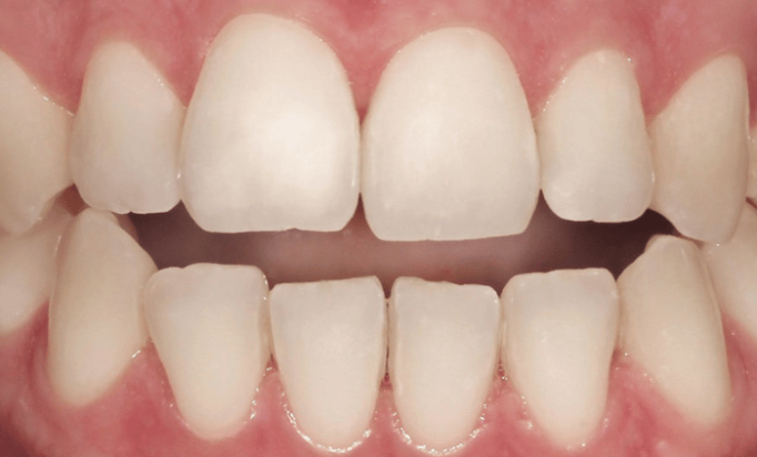 Before - Bond Dental London
