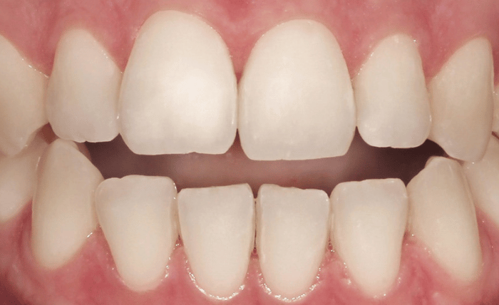 Before - Bond Dental London