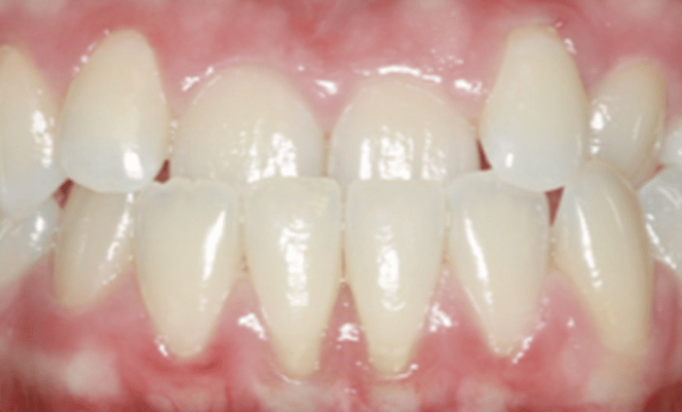 Before - Bond Dental London