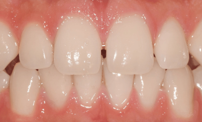 Before - Bond Dental London