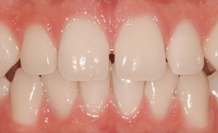 Before - Bond Dental London