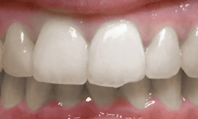 Before - Bond Dental London