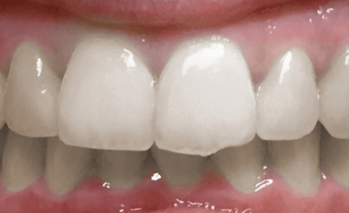 Before - Bond Dental London